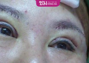 Nâng cung mày bị hỏng: Nguyên nhân, khắc phục triệt Thẩm mỹ Hồng Hà