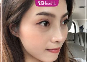 Có nên nâng mũi bọc sụn không? 3 ưu điểm khi nâng mũi bọc sụn