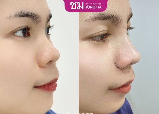 Chiếc mũi cao thanh thoát sau nâng