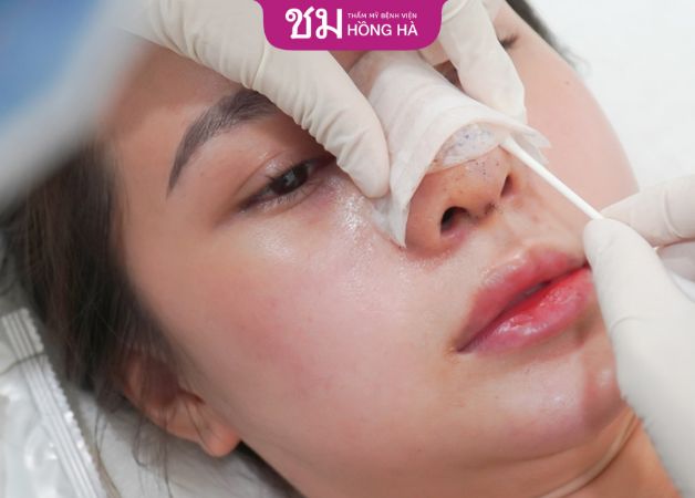 Chăm sóc hậu phẫu nâng mũi Thái Lan đúng cách