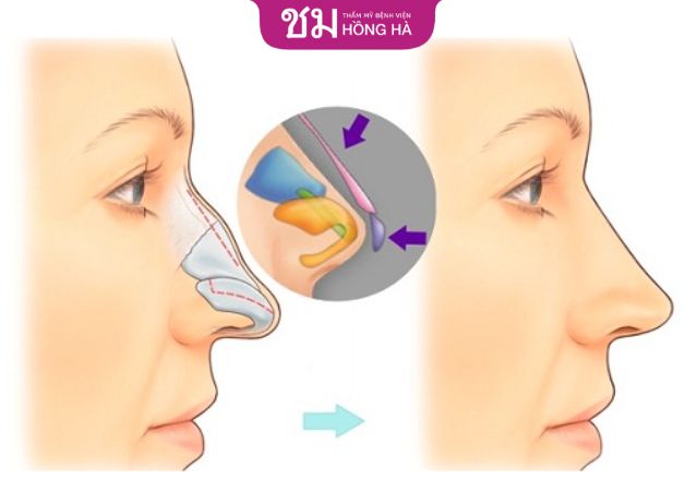 Nâng mũi bọc sụn có ảnh hưởng gì không - Chuyên gia giải đáp