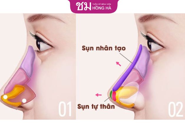 Chọn sụn phù hợp khi nâng mũi