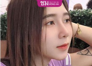 Nâng mũi cấu trúc – Giải pháp sở hữu mũi đẹp không khuyết điểm