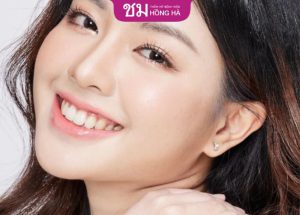 Nâng mũi L Line – 60 Phút sở hữu dáng mũi cao tây hút hồn