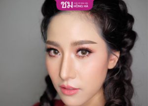 Nâng mũi Lline/Sline tạo dáng mũi cao đẹp tự nhiên