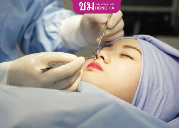 Nâng mũi mấy ngày tháo nẹp phụ thuộc vào tay nghề bác sĩ