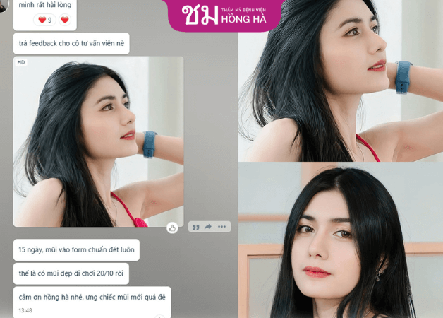 Khách hàng gửi feedback sau khi nâng mũi chuẩn Thái