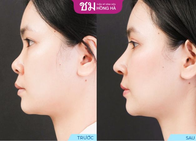 Dáng mũi cao và thẳng sau khi nâng mũi