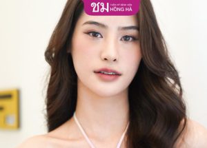 Nâng mũi S Line bọc sụn tai an toàn, mũi cao đẹp tự nhiên