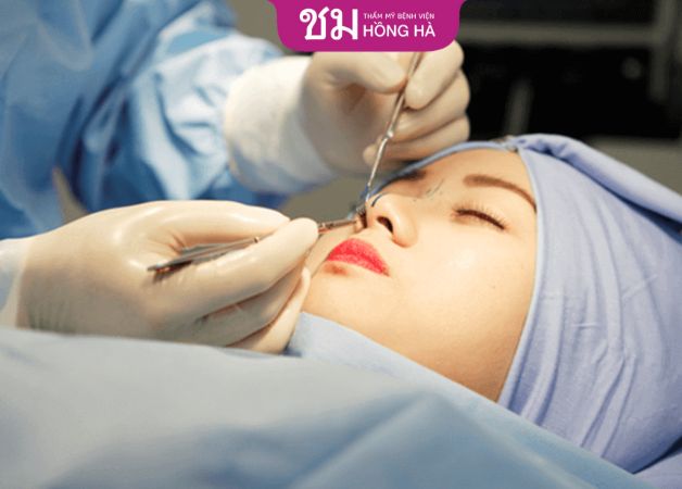 Bác sĩ thực hiện nâng mũi bọc sụn tai S Line