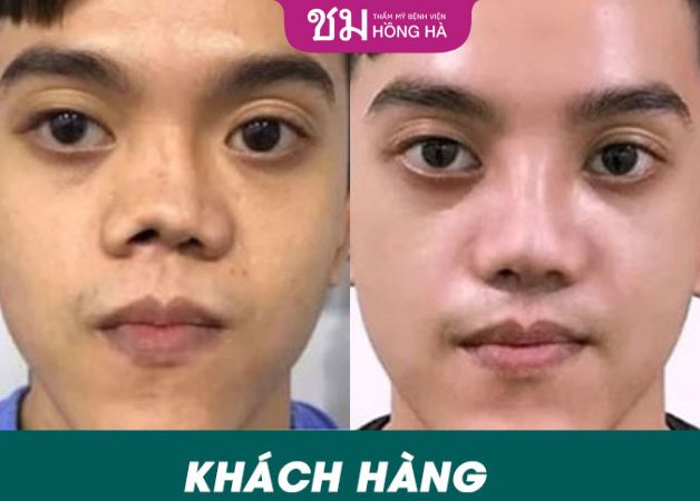 Rất nhiều ca thẩm mỹ mũi hỏng đã được khắc phục với nâng mũi sụn sườn Nanoform