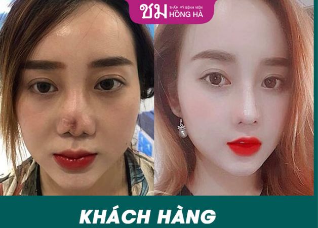 Bác sĩ Thẩm mỹ Bệnh viện Hồng Hà cứu nguy ngoạn mục