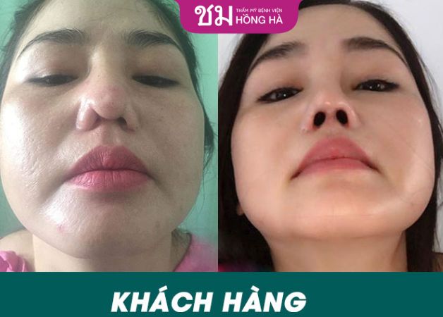 Lấy lại vẻ đẹp cho chiếc mũi