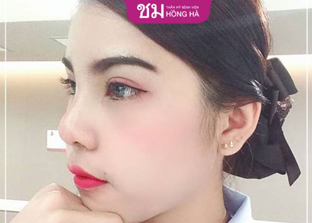 Dáng mũi được bảo hành vĩnh viễn