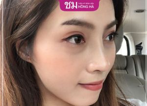 Nâng mũi Sụn sườn Nanoform – Chỉnh sửa dáng mũi hỏng hoàn hảo