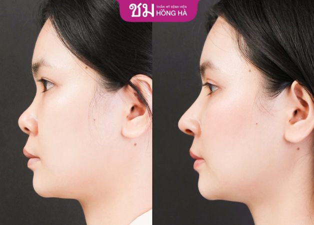 Khách hàng khắc phục tình trạng mũi tẹt thành công