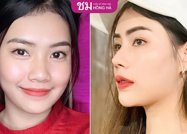 Chiếc mũi cao thẳng và đẹp tự nhiên sau khi nâng mũi