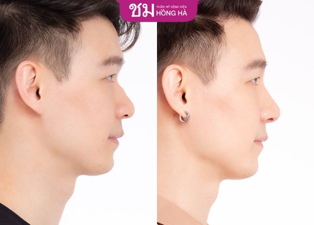 Khách hàng sở hữu dáng mũi đẹp và cuốn hút