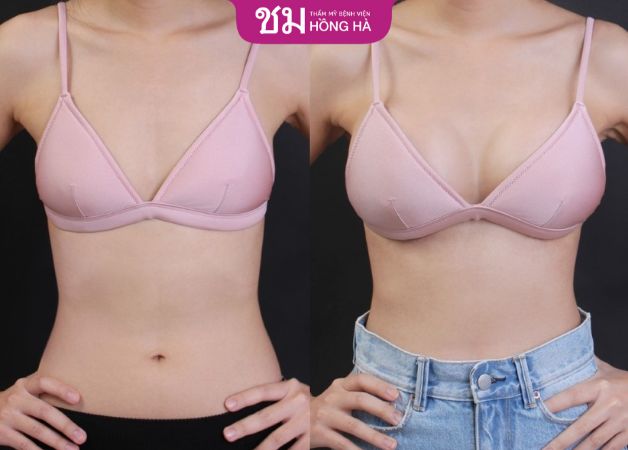 Khách hàng sau khi nâng ngực được 2 tháng tại Thẩm mỹ Bệnh viện Hồng Hà