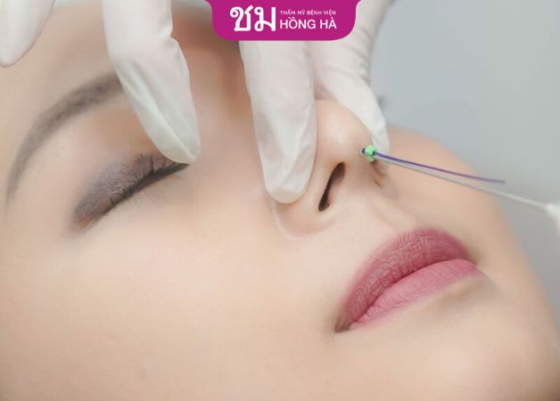 Nâng mũi không phẫu thuật