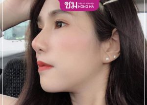 Quá trình nâng mũi bọc sụn an toàn, đạt chuẩn Bộ Y Tế