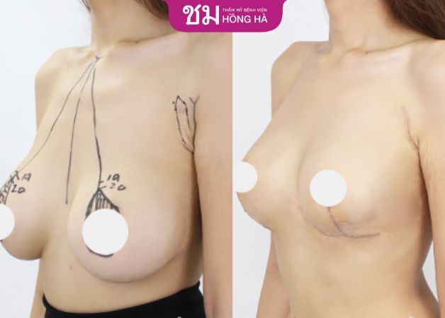 Hình ảnh trước sau của khách hàng khi thu gọn vú