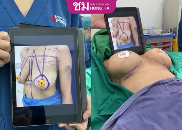 Hình ảnh trước sau của khách hàng ngay khi vừa kết thúc quá trình treo ngực sa trễ