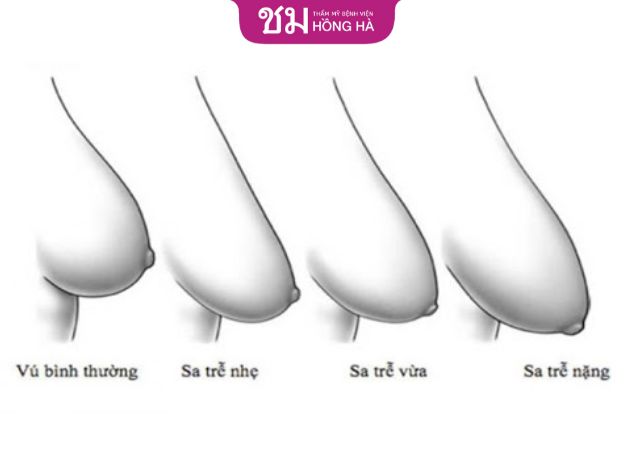 Treo ngực sa trễ giá bao nhiêu phụ thuộc tình trạng ngực