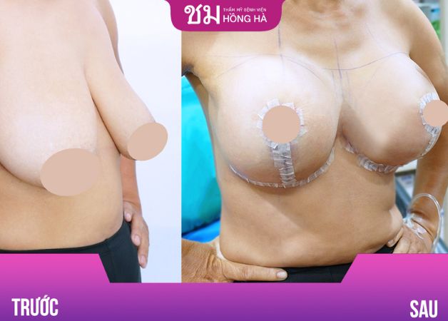 Khách hàng treo sa trễ kết hợp nâng ngực sau 1 tháng
