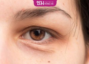 Xóa rãnh lệ – Giải pháp hoàn hảo lấy lại tuổi xuân