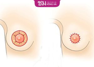 Thu nhỏ quầng vú – làm đẹp nhũ hoa 40 phút tại Hồng Hà