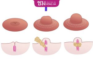 Kéo núm vú bị tụt: Nguyên nhân và cách khắc phục hiệu quả