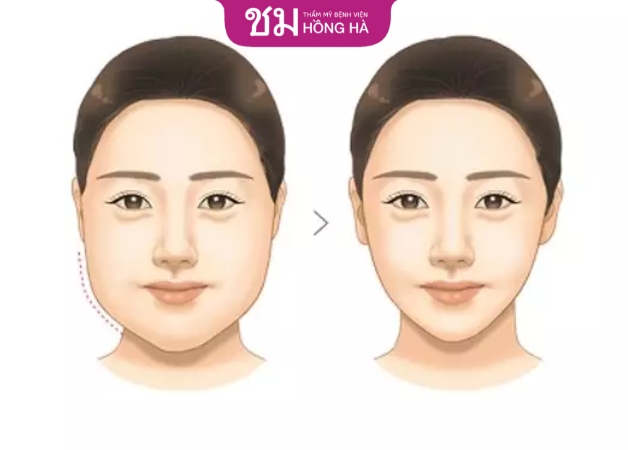 Nguyên nhân dẫn đến mỡ mặt