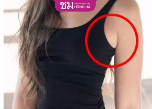 Hút mỡ nách an toàn không? 6 Tiêu chí hiệu quả và an toàn