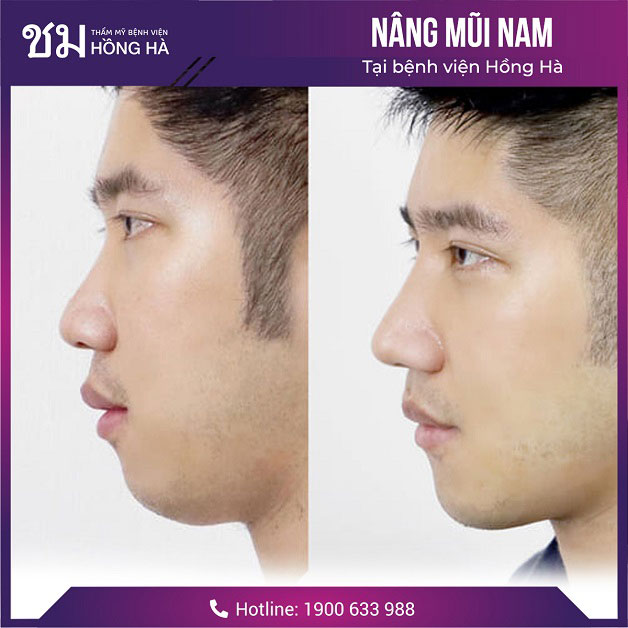 Dáng mũi cao với đường cong hoàn hảo