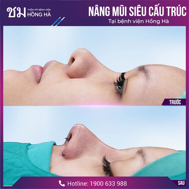Dáng mũi đẹp tự nhiên sau nâng tại Thẩm mỹ Bệnh viện Hồng Hà