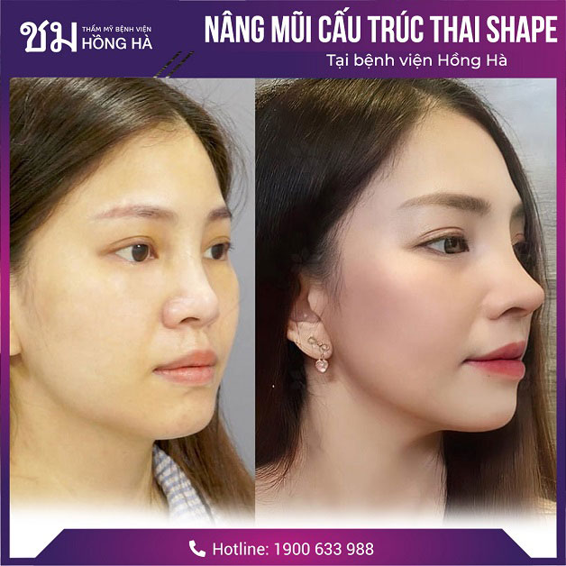 Mũi S Line giúp gương mặt trẻ trung, xinh đẹp hơn