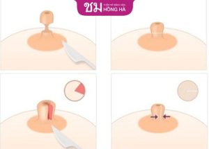 Thu nhỏ núm vú – Giải pháp cân đối đầu ngực, hài hòa và quyến rũ