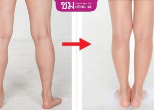 Hút mỡ bắp chân ở đâu tốt: 4 tiêu chí lựa chọn