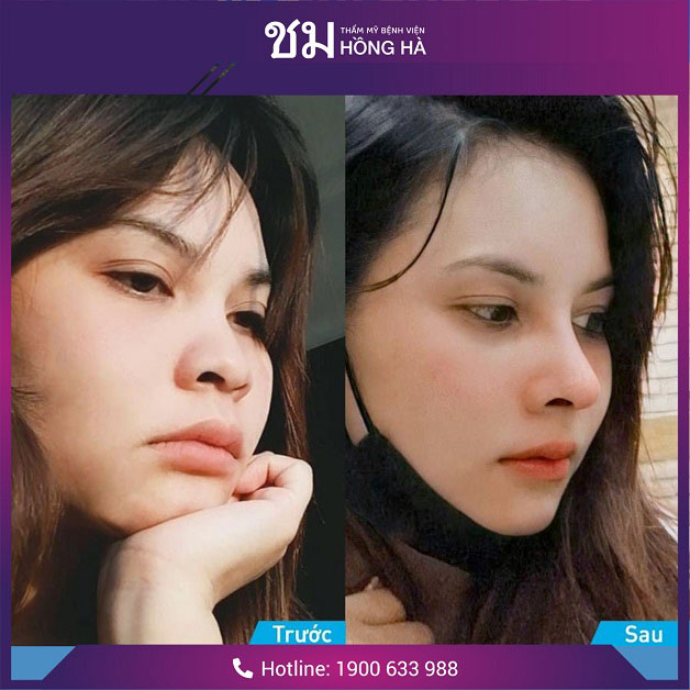 Kết quả nâng mũi sau 2 tuần