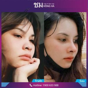 Mũi hếch: Ý nghĩa tướng số và cách khắc phục hiệu quả