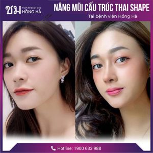 Nâng mũi Thái Lan: Lột xác với mũi đẹp tự nhiên, cuốn hút