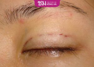 Nhấn mí xong có tháo ra được không? Trường hợp tháo chỉ