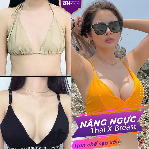Phương pháp nâng ngực theo công nghệ Thái Lan độc quyền