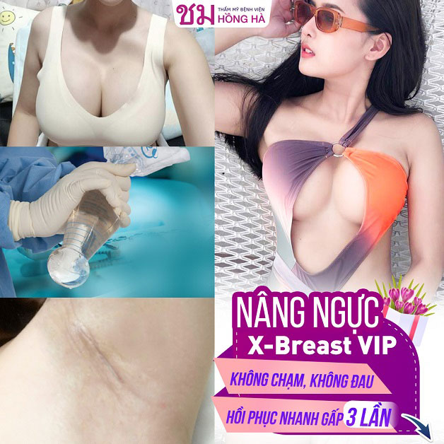 Ưu điểm khi thẩm mỹ ngực tại Thẩm mỹ Bệnh viện Hồng Hà