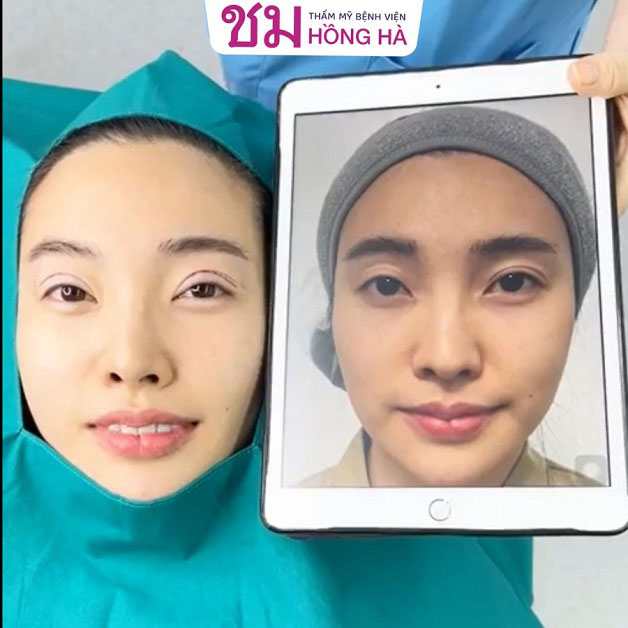 Mắt một mí được tái tạo thành đôi mắt 2 mí rõ nét