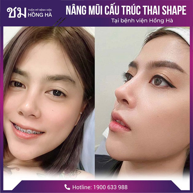 Khách hàng tự tin với dáng mũi đẹp chuẩn Thái