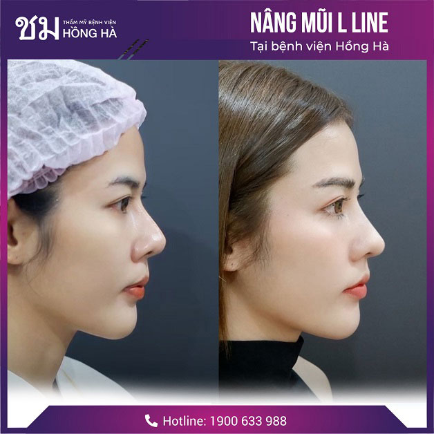 Dáng mũi L Line đẹp chuẩn gái Thái