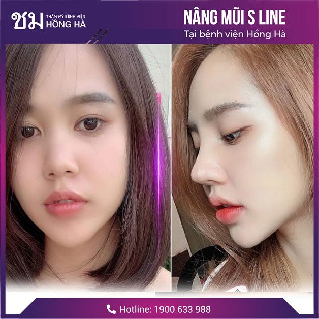 Dáng mũi đẹp, hài hòa với khuôn mặt