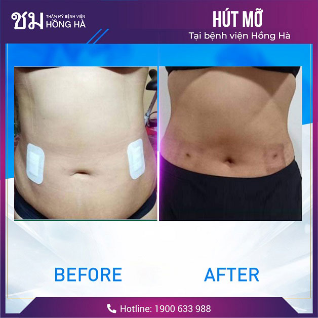Bụng trở nên thon gọn và cân đối sau khi khách hàng hút mỡ tại Hồng Hà